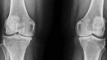 Pediatric Radiology : Rickets Radiology : Rickets Radiology ...