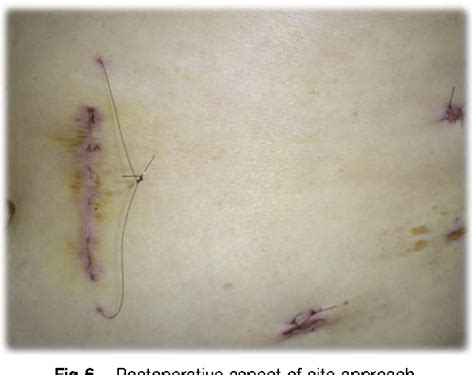 Image result for Hand-Assisted Nephrectomy