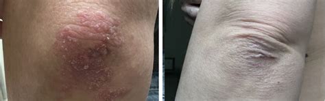 3 Step Dermatitis Complete Care Bundle – Oleum Cottage