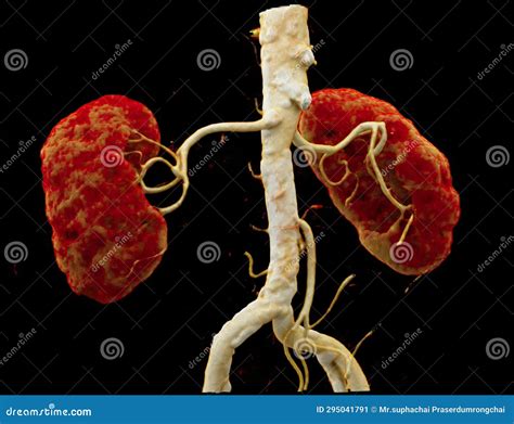 Kidney Artery Surgery at Layla Swallow blog