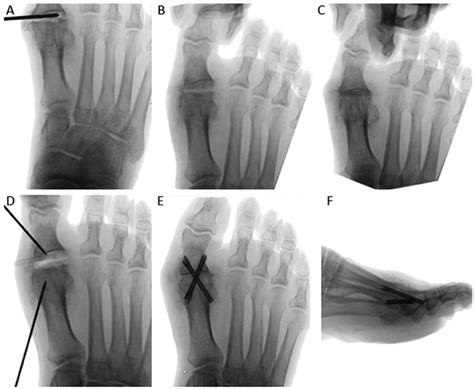 Percutaneous first metatarsophalangeal joint arthrodesis: A ...