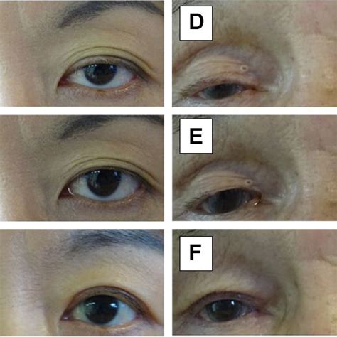 Image result for Levator Resection Surgery