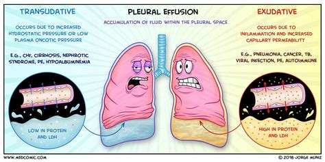Pleural Effusions: Transudate vs. Exudate | MedComic
