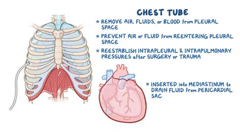 Chest Tube Insertion