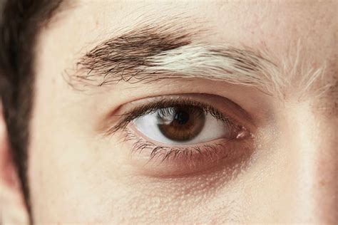 Vitiligo Does It Affect Hair