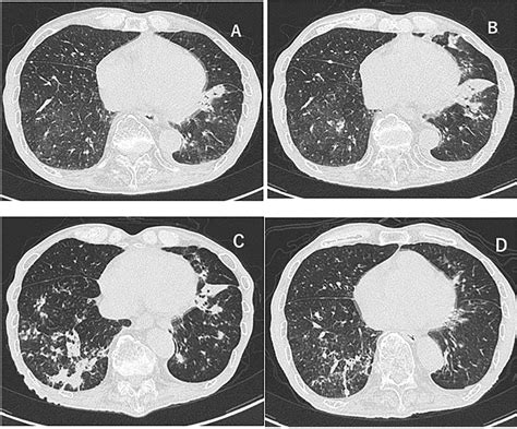 Figure 2 from Mycobacterium avium complex lung disease in a patient treated with an immune ... - mac lung infection