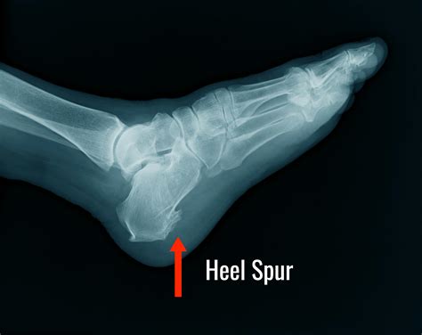 Heel Spur X Ray
