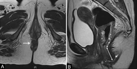 (A) Axial T2W MRI showing anal verge (arrow). (B) Sagit | Open-i