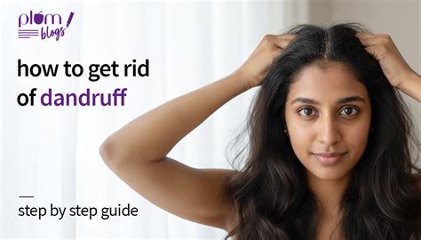 How to Get Rid of Dandruff: Causes, Treatment & Prevention Tips
