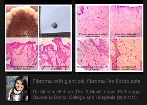 Fibroma — ORAL PATHOLOGY-SAVEETHA