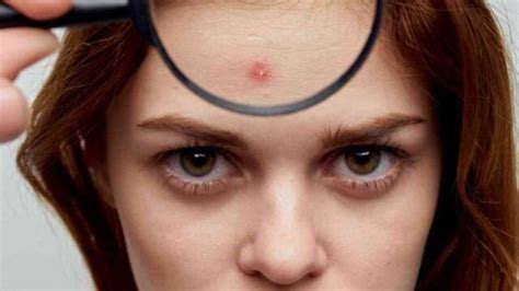 Why Do Pimples Occur? Causes, Prevention, and Home Remedies | Buy Wow