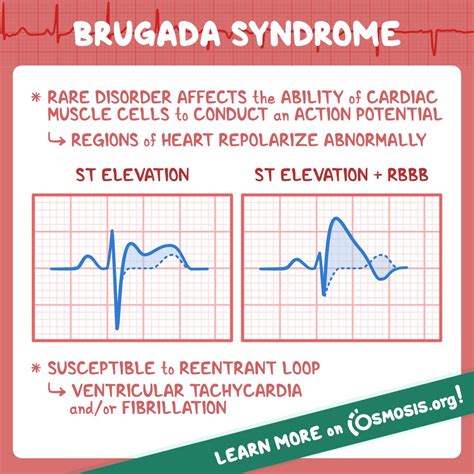 Brugada Syndrome Heart