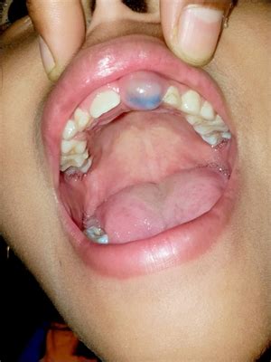 Image result for Exploding Mouth Cyst
