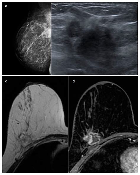 Special Types of Breast Cancer: Clinical Behavior and Radiological ...