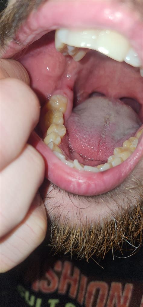 Giant cut on back of gums? : r/askdentists