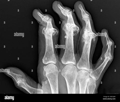 Psoriatic arthritis of the hand. X-ray of one of the hands of a woman with psoriatic arthritis ...