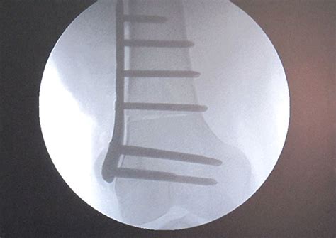 Varising Derotational Distal Femoral Osteotomy