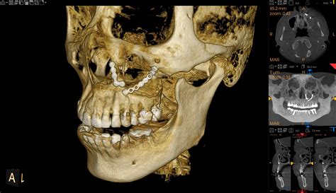 CS 9600 Dental CBCT Scanner | Premium 3D Imaging & Airway Analysis