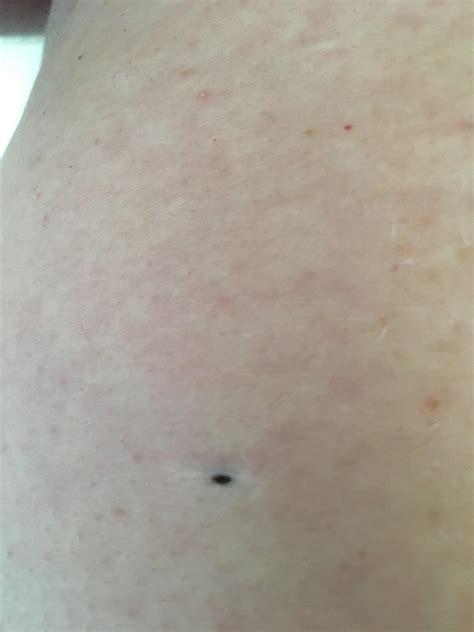 How To Remove A Back Blackhead at Tanner Troy blog