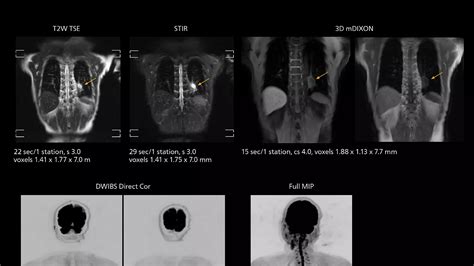 Ingenia 3T upgrade to Elition X - Philips