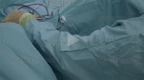 Image result for Turp Procedure Explained