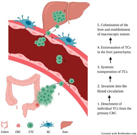 Surgery for Colorectal Cancer: A Trigger for Liver Metastases Development? New Insights into the ...