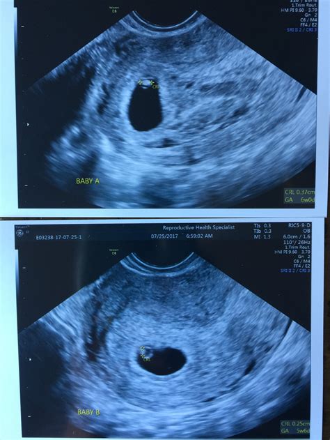 6 week Ultrasound — The Bump