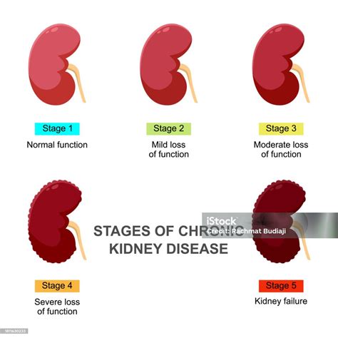 Stages Of Chronic Kidney Disease Infographic Concept Vector ...