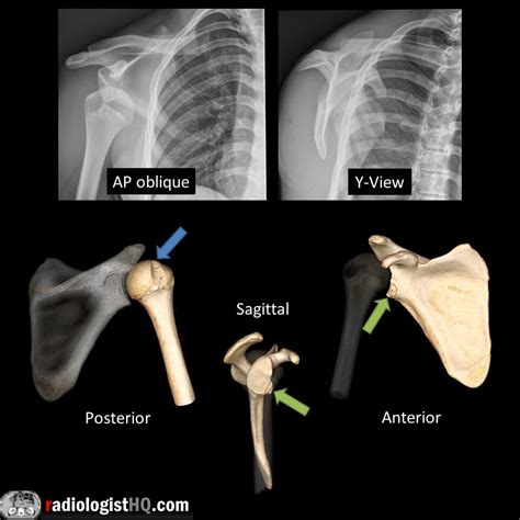 X Ray Of Anterior Shoulder Dislocation at Joy Frederick blog