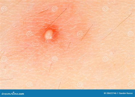 Image result for Blood Red Pimple