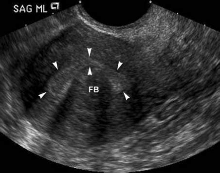 Image result for Pelvic Spring Test