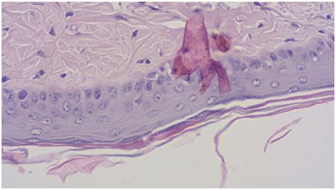 Anti-Psoriasis Effect of Diclofenac and Celecoxib Using the Tail Model ...