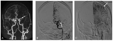 Brain Sciences | Free Full-Text | MR Angiography in Assessment of ...
