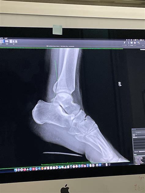 Posterior malleolus fracture : r/brokenbones