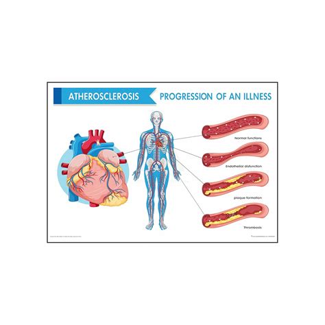 Anne Print Solutions® Atherosclerosis progression of all illnesses ...