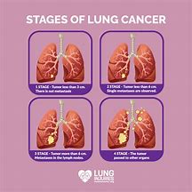 Lung Cancer 的图像结果