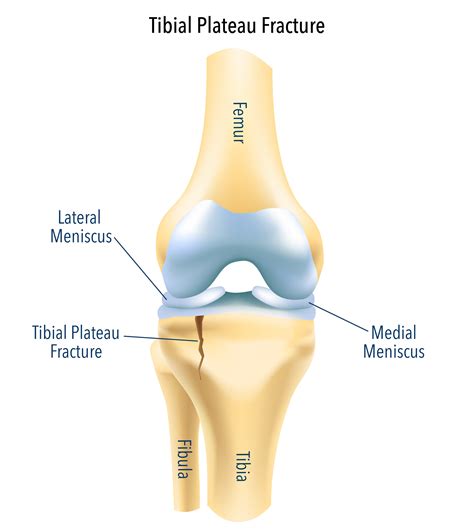 Tibial Plateau Fracture Treatment | Tibial Plateau Fracture Surgery