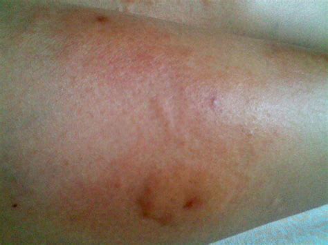 被蚊虫叮咬后 皮肤特别是小腿上会大面积红肿 很痒~一开始是小红疙瘩，一两天后就会变成大片据说是丘疹性荨_百度知道