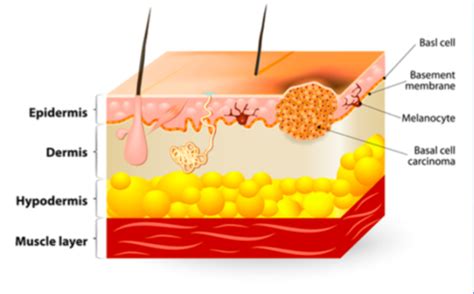 exam 3 - skin cancer Flashcards | Quizlet