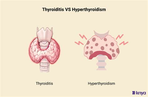 Image result for hyperthyroidism