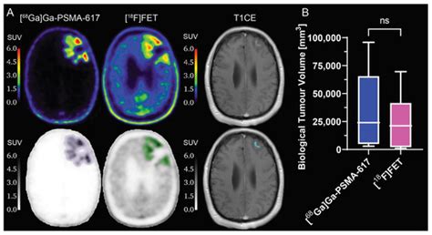 Comparison between [68Ga]Ga-PSMA-617 and [18F]FET PET as Imaging ...