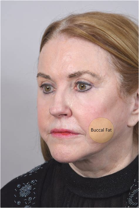 Surgical Management of the Buccal Fat Pad - Advances in Cosmetic Surgery