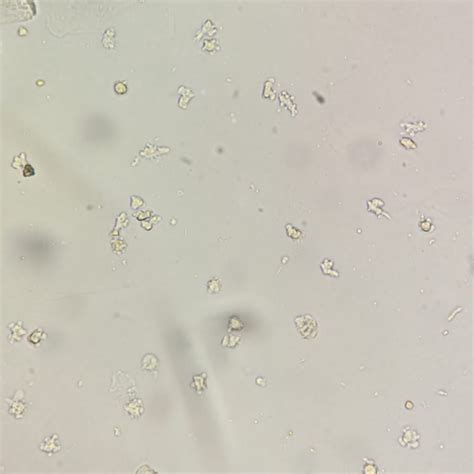 WBCs in Urine: Identification & Significance - MedLabBuddy