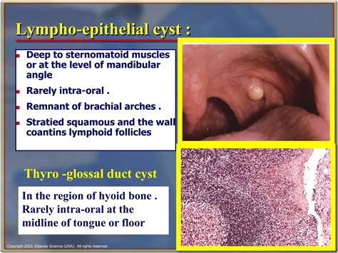 Jaw bone cyst | PPTX