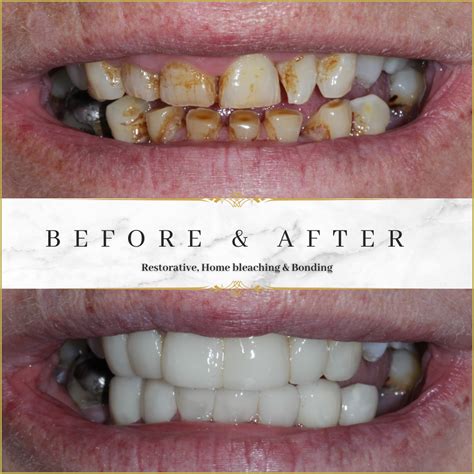 Dentist Bonding Teeth