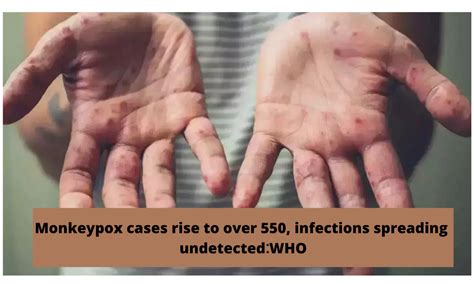 Monkeypox cases rise to over 550, infections spreading undetected: WHO