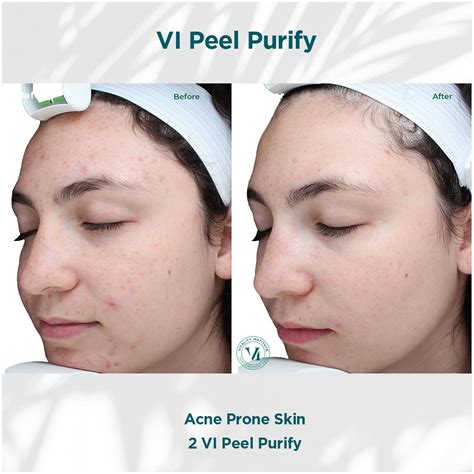 Med Spa Chemical Peel | #1 Proven Chemical Peel Specialist