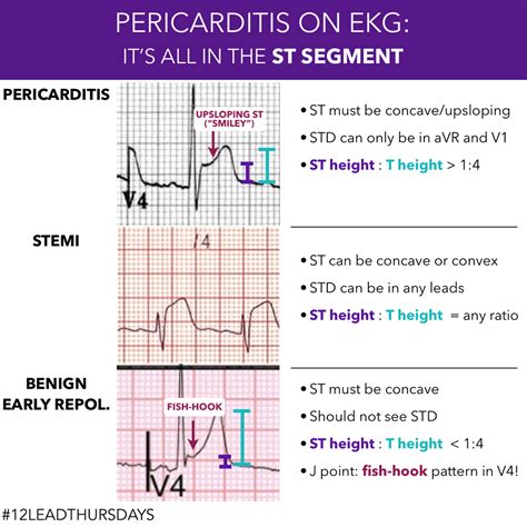 Stemi Vs Pericarditis Ecg