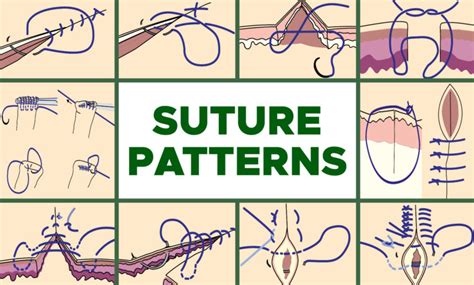 Image result for Continuous Suture Patterns