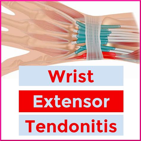 Wrist Extensor Tendons